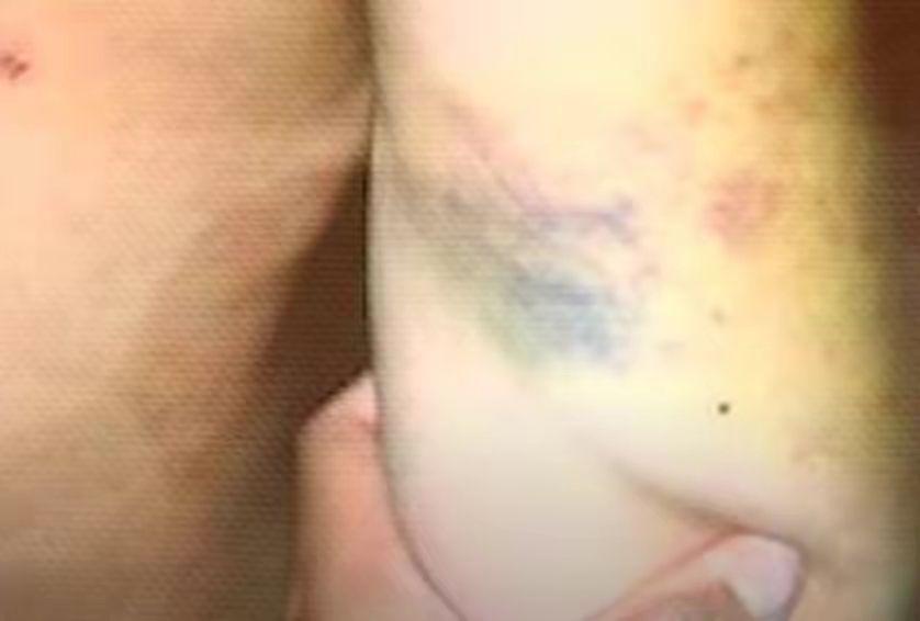 รอยฟกช้ำตามร่างกาย